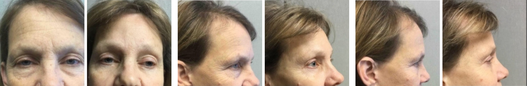 Best Brow Lift In Michigan () Best Brow Lift In Michigan ()