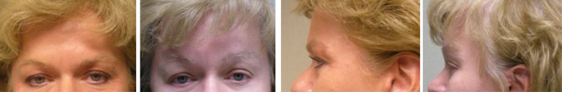 Best Brow Lift In Michigan () Best Brow Lift In Michigan ()