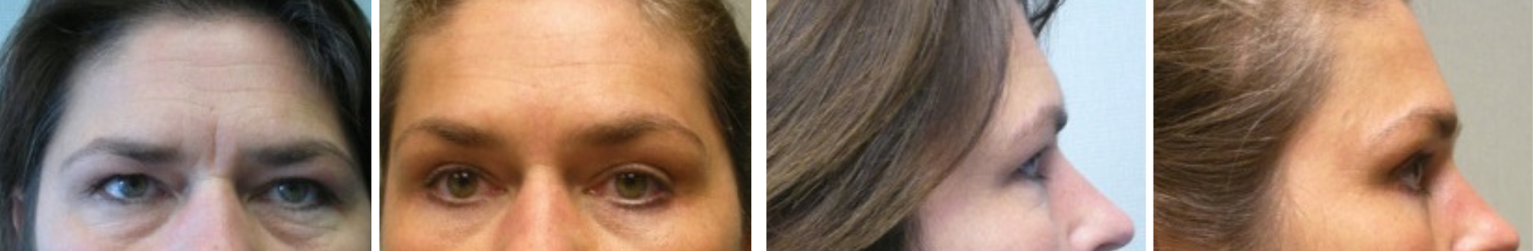 Best Brow Lift In Michigan () Best Brow Lift In Michigan ()