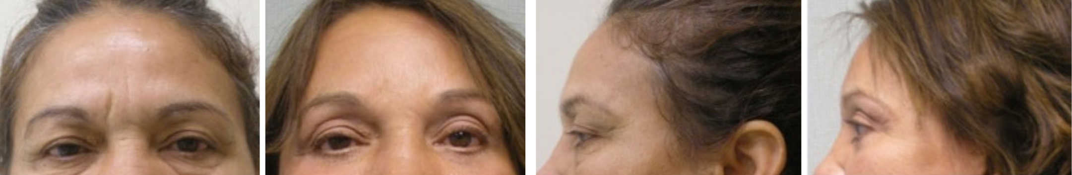 Best Brow Lift In Michigan () Best Brow Lift In Michigan ()