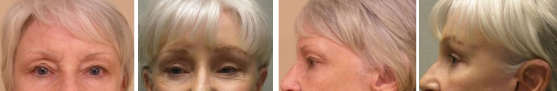 Best Brow Lift In Michigan () Best Brow Lift In Michigan ()