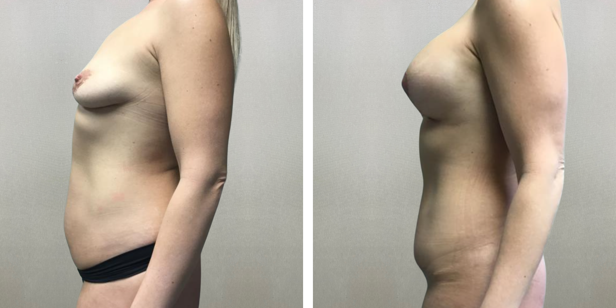 Best Mommy Makeover in Michigan ()