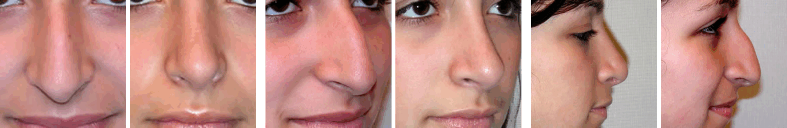 Best Rhinoplasty in Michigan