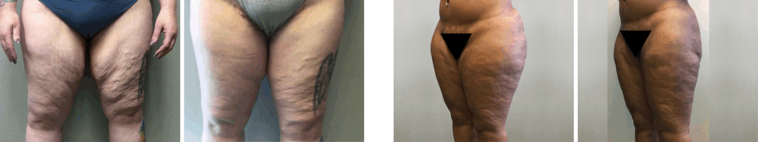 Best Thigh Lift In Michgian () Best Thigh Lift In Michgian ()