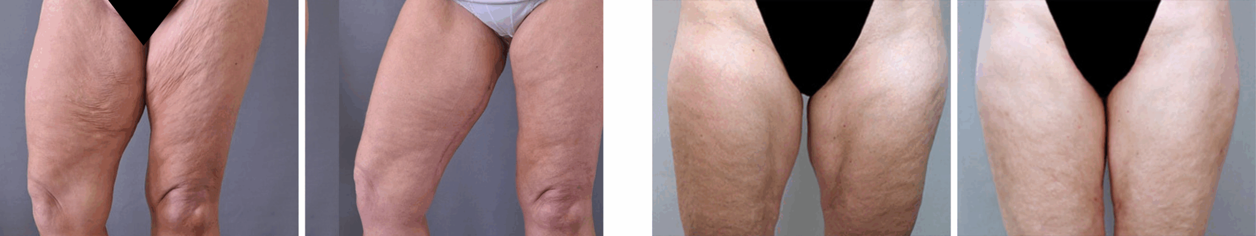 Best Thigh Lift In Michgian