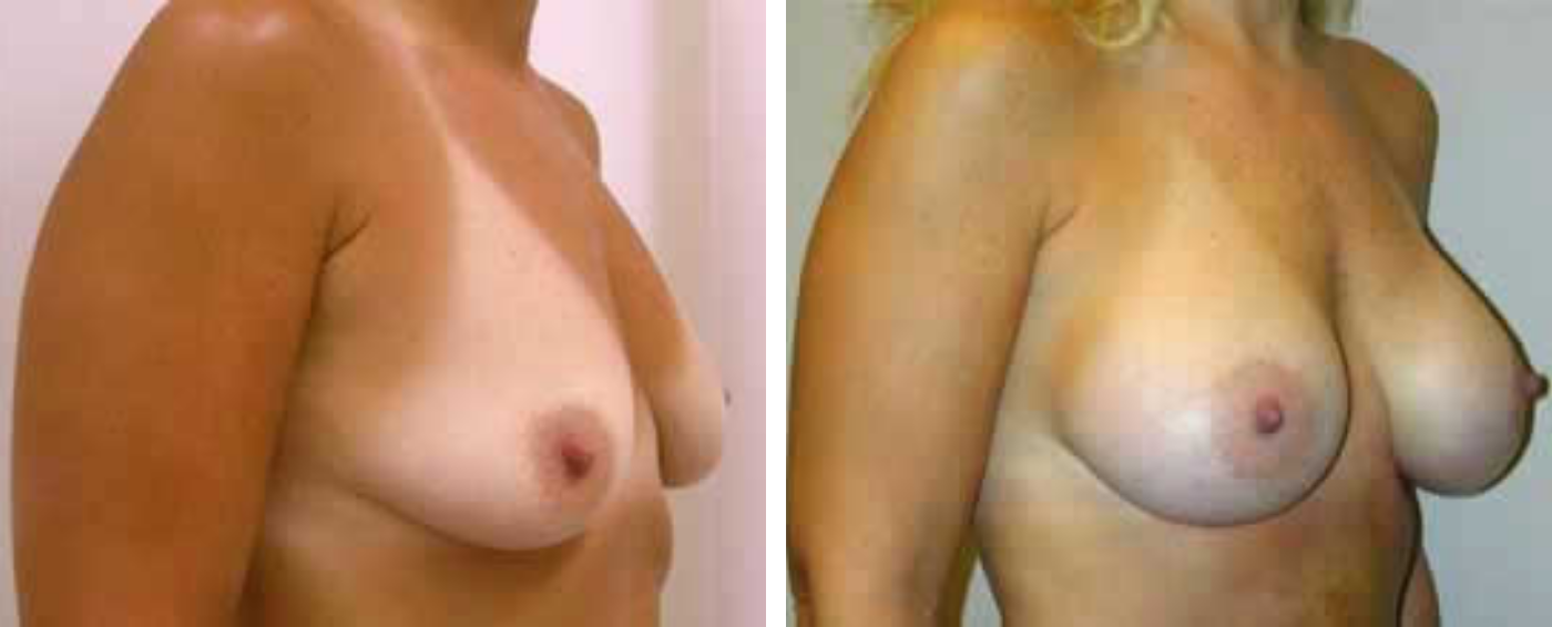 Breast Augmentation with Crescent lift b