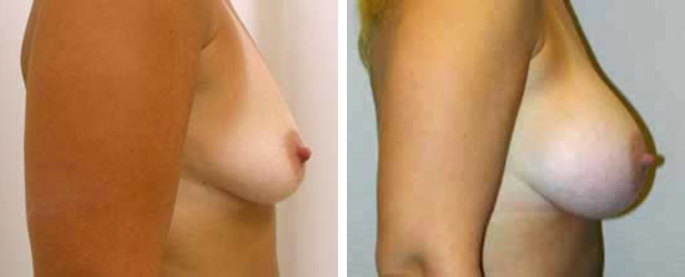Breast Augmentation with Crescent lift c