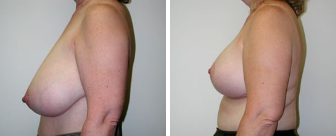 Breast Reduction C