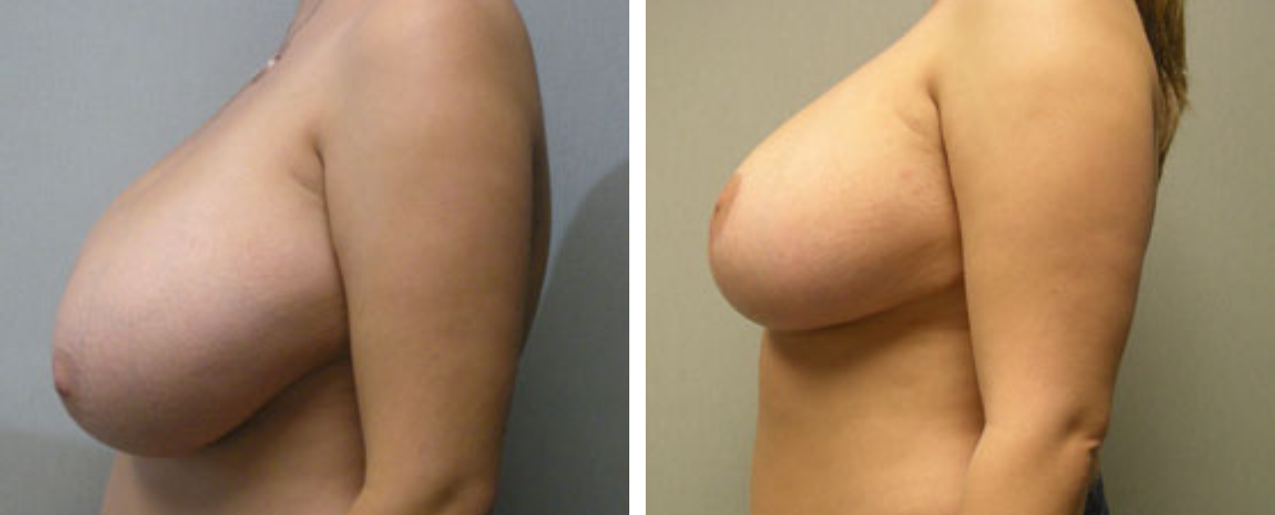 Breast Reduction C