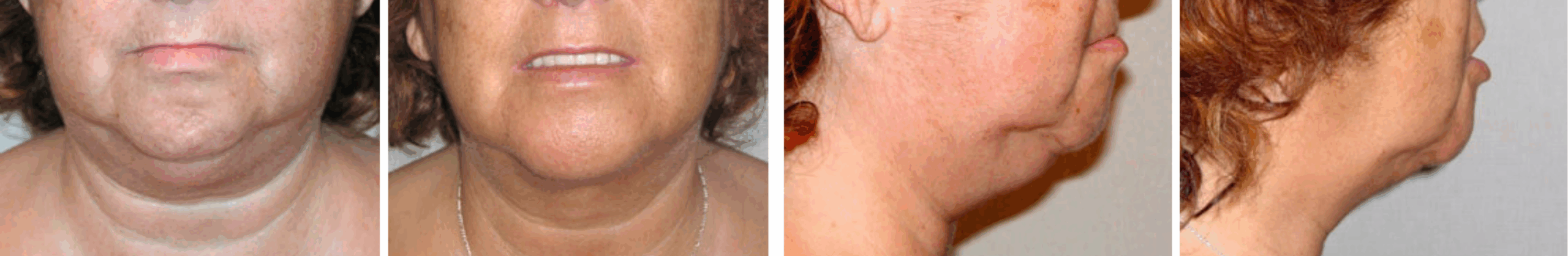 Chin Lipo In Michigan