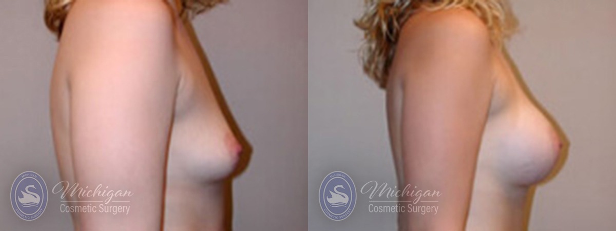 Michigan Cosmetic Surgery Southfield Breast Augmentation P