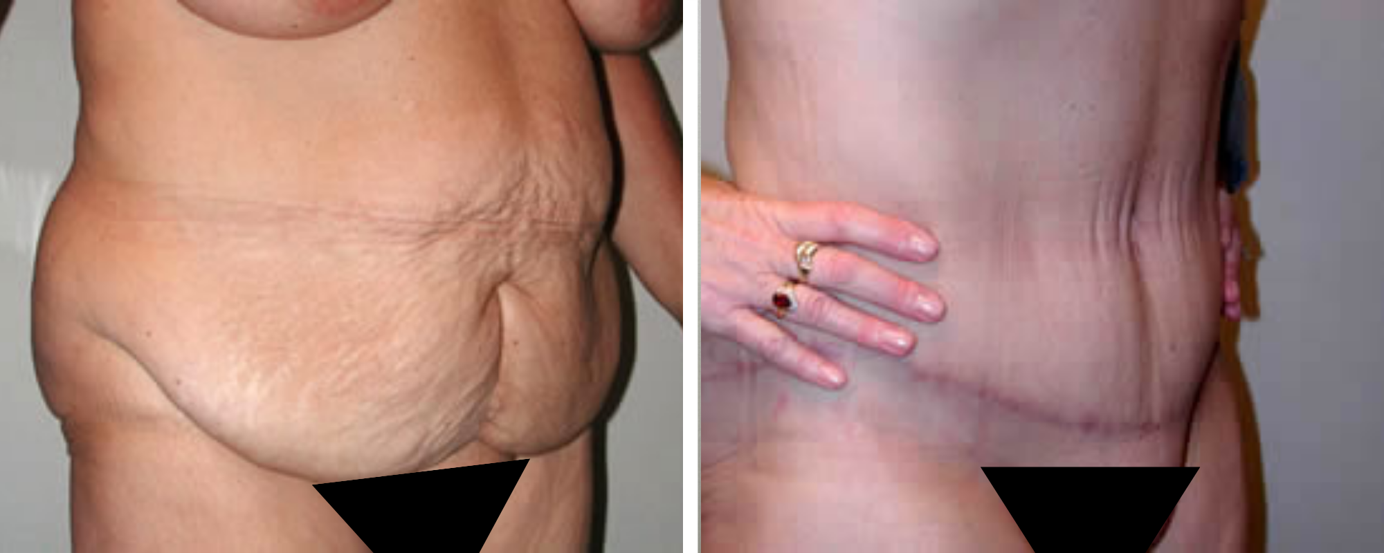 Weight Loss Makeover Body Lift in Michigan ()