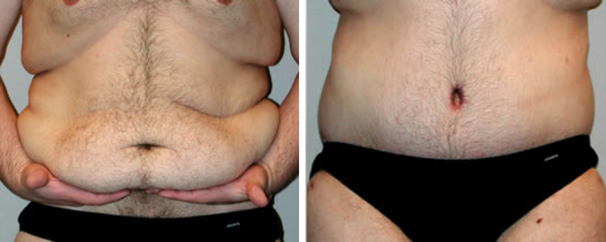 Weight Loss Makeover Body Lift in Michigan ()