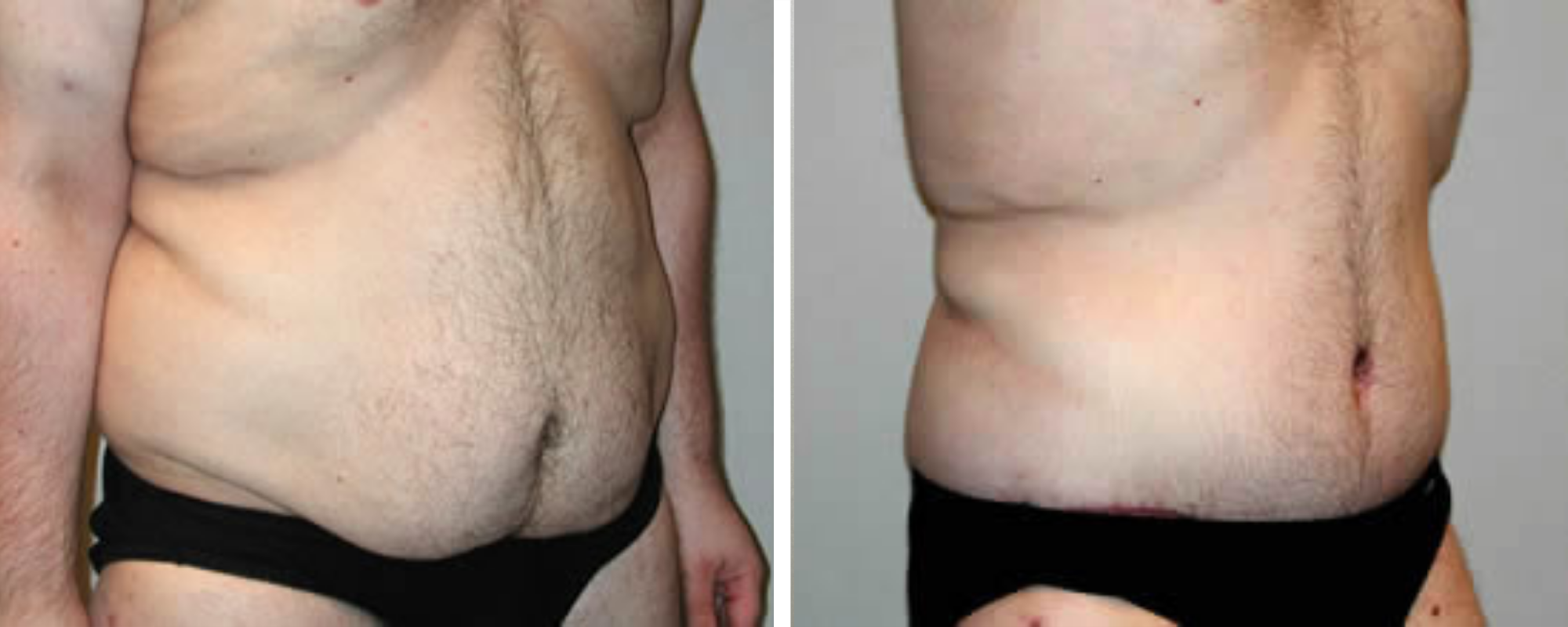 Weight Loss Makeover Body Lift in Michigan ()