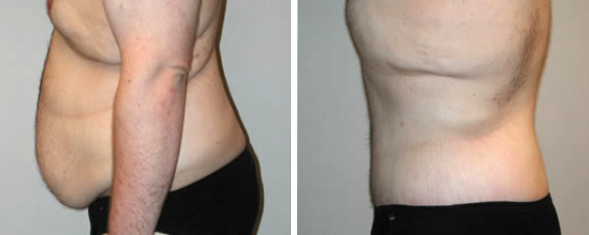 Weight Loss Makeover Body Lift in Michigan ()