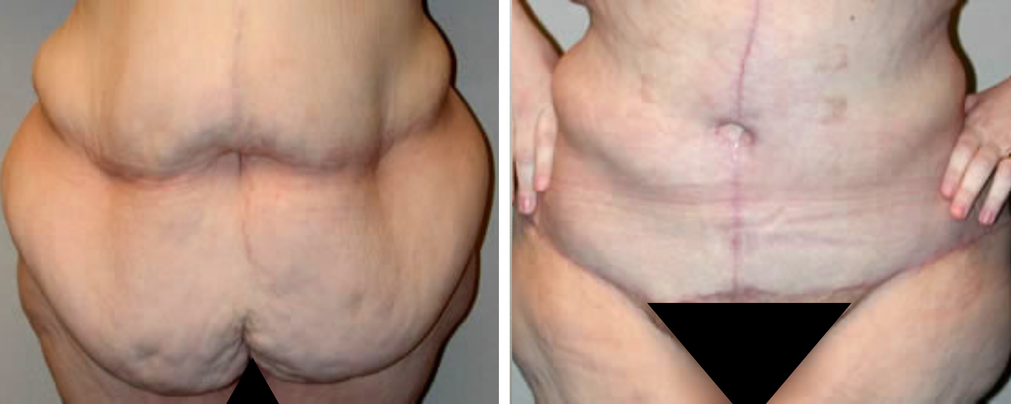 Weight Loss Makeover Body Lift in Michigan