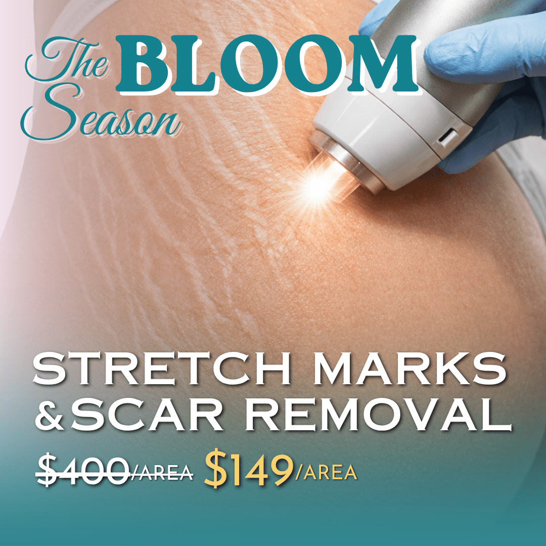 Stretch Marks Removal in Michigan Stretch Marks Removal in Michigan